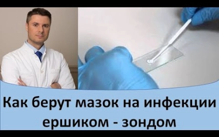 Как берут мазок на инфекции ершиком - зондом