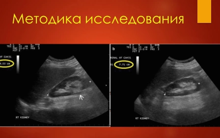 УЗИ почек. Станислав Феданов.